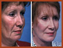 face and chin implants 10 img