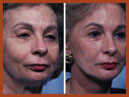 face and chin imaplants image 11