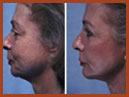 faceandchinimplants image 12