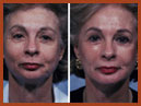 faceandchinimplants 13