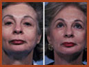 faceandchinimplants 14