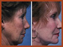 face and chin implants 09 img