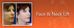 face and Neck Lift Image 1a