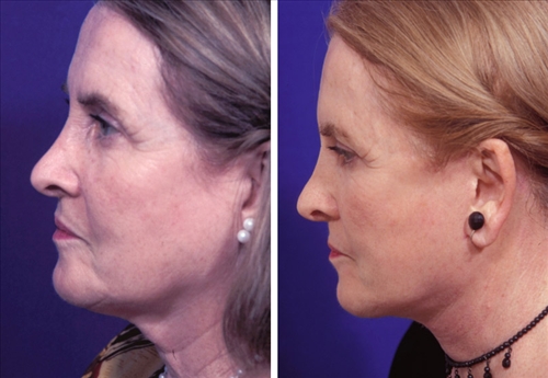 face and neck 17 image