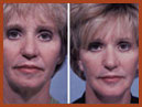 face and neck img 12