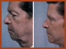 faceand neck img 25