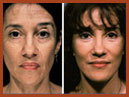faceand neck img 26