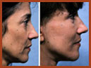 faceandneck img 28