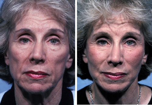 faceliftandmidfaceimplant img 17