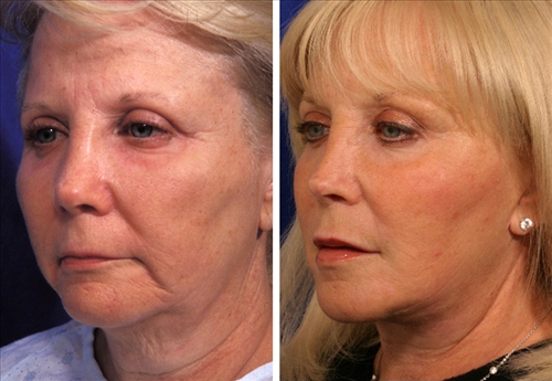 facelift midface implants 25 img