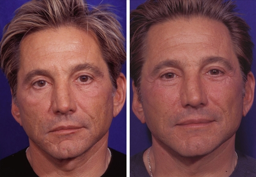 faceliftandmidfaceimplant 9 image