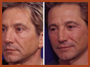 face and chin implants 10a img