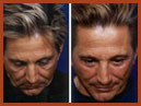 face lift and midface imaplants img 11