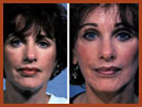 face lift and midface imaplants img 12