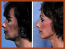 faceliftmidface implant 13 img