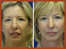 faceliftmidface implant 14 img