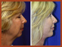 face lift midface implant15a