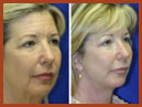 facelift and midface implant 16a