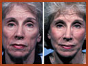 faceliftandmidfaceimplant img 17
