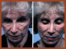 face and neck image 18a