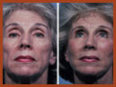 face and neck 19a img
