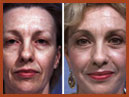 faceliftandmidfaceimplant img 21