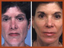 face lift and mid face implants img 22