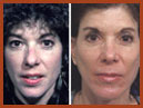 face and mid face implants 23