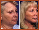 face and mid face implants 24