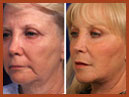 faceliftmidface implant 25 image
