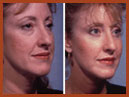 facelift and midface implants img 7