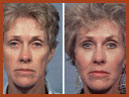 facelift and midface implants img 8