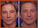 face and chin implants 9 img
