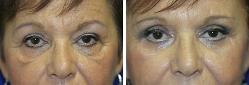 midfacelift9.jpg
