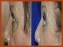 midfacelift 10 image