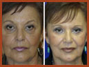 miface implants img 11