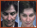 midface lift img 12