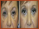 midfacelift9.jpg
