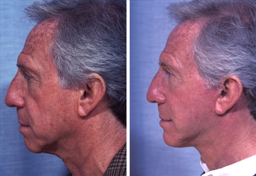 faceandchinimplants img 01