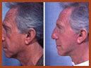 face and neck image 1a
