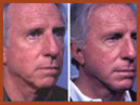 face and neck image 2a