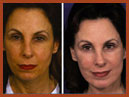 faceandchinimplants 3 img