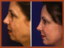 faceandchinimplants 4 img