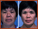 faceandchinimplants image 5