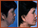 faceandchinimplants image 6