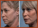 faceandchinimplants 7a img
