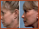 faceandchinimplants 8a img