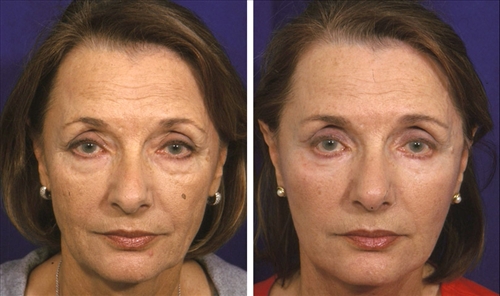 face and nek image 01