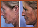 face and neck 05 image