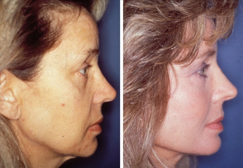 faceliftandmidfaceimplant 1 image